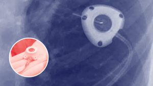 When Medical Devices Go Wrong: Inside the Bard PowerPort Lawsuits 